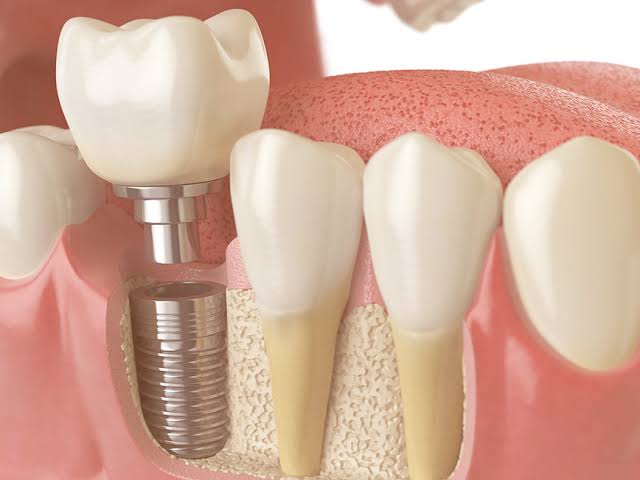 Implante Dentário