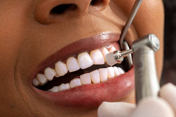 Limpeza Dental (Profilaxia)