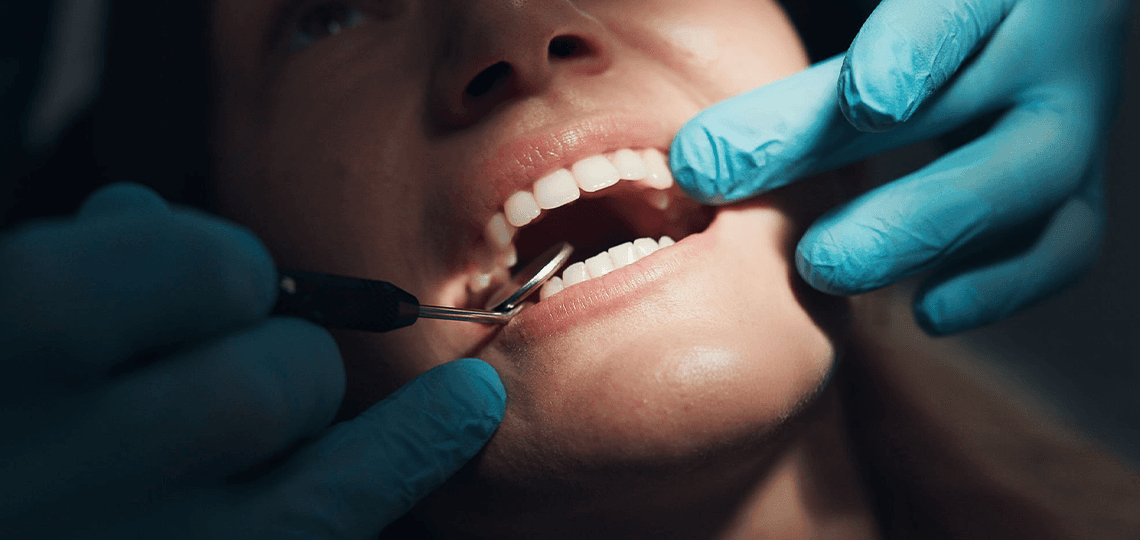 Autoexame bucal: Como identificar sinais precoces do câncer de boca.