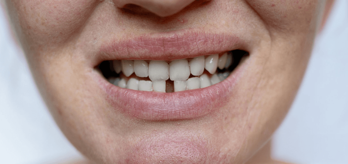 Espaço entre os dentes (diastema): Opções para fechar ou manter.