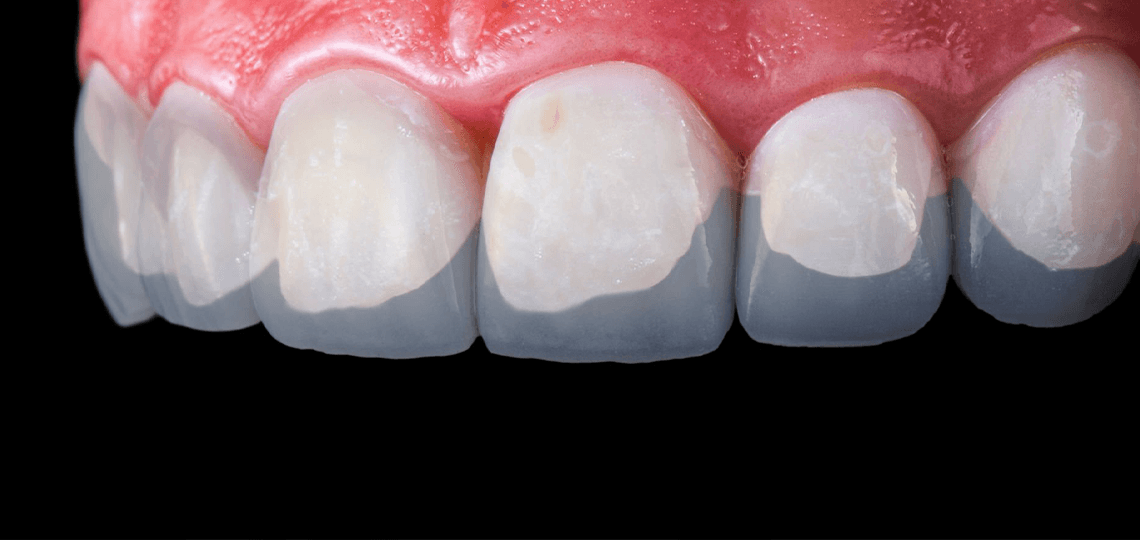 Facetas de resina: Como transformar o sorriso em sessão única?