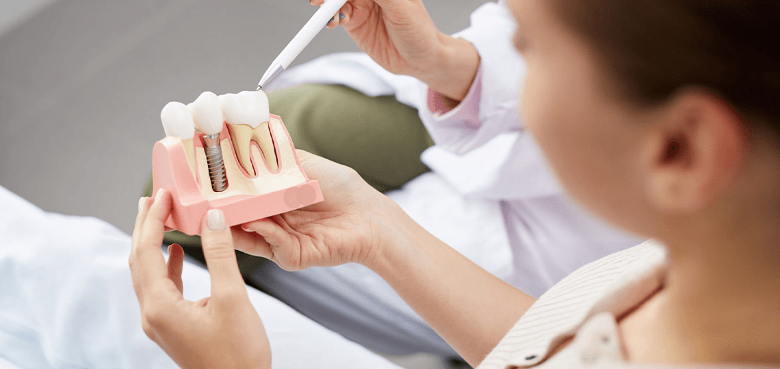 Implante de carga imediata: É possível sair com dentes no mesmo dia?