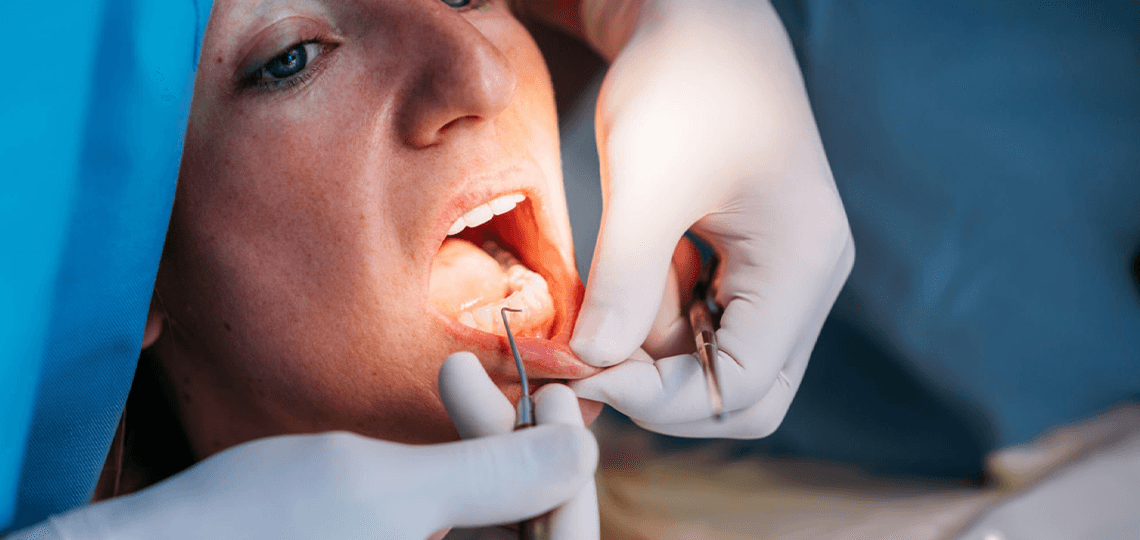 O que é placa bacteriana e como ela destrói o esmalte dental.