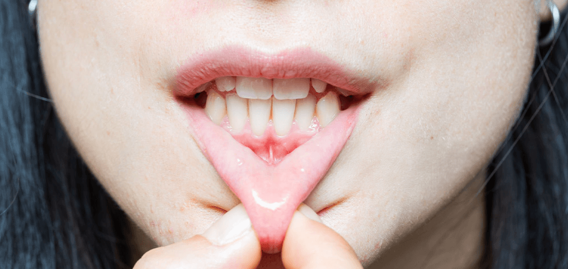 Retração gengival: Por que a raiz do dente fica exposta?
